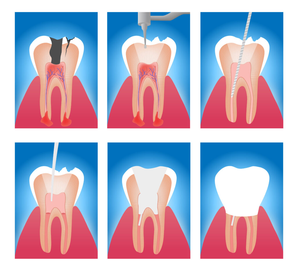 endodonzia_milano