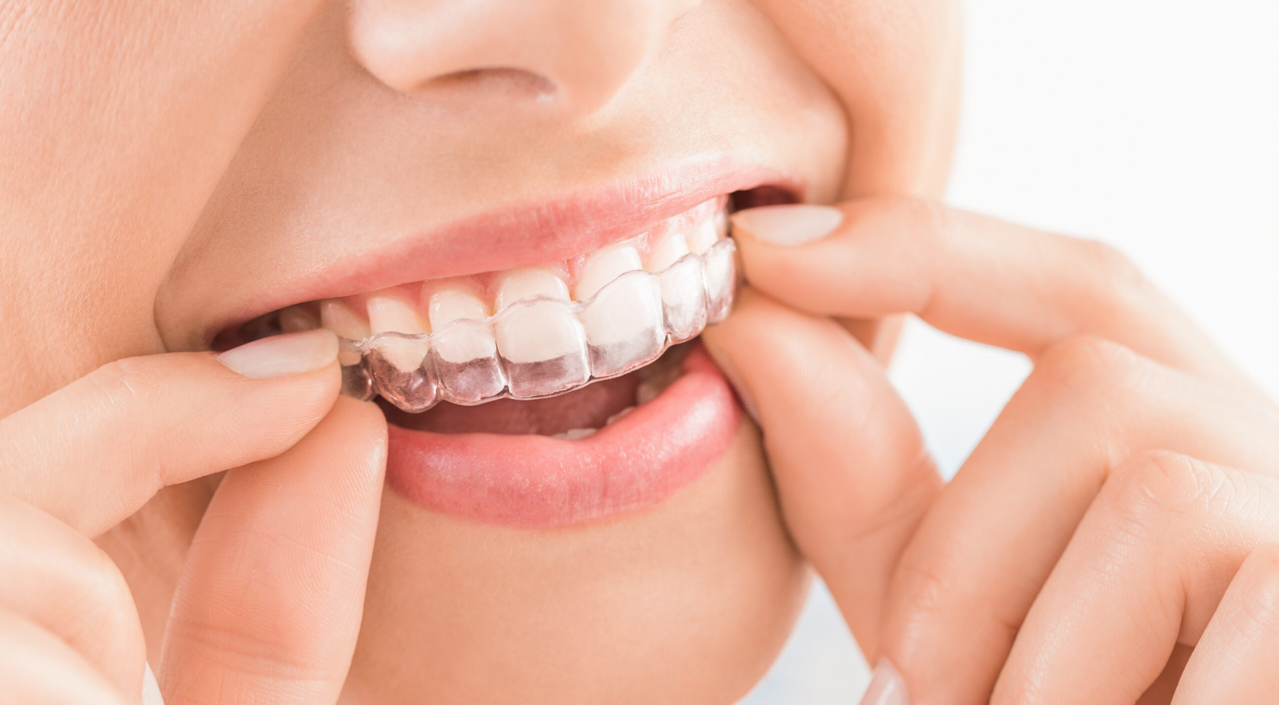 Apparecchio Denti Invisibile: Per chi è indicato?