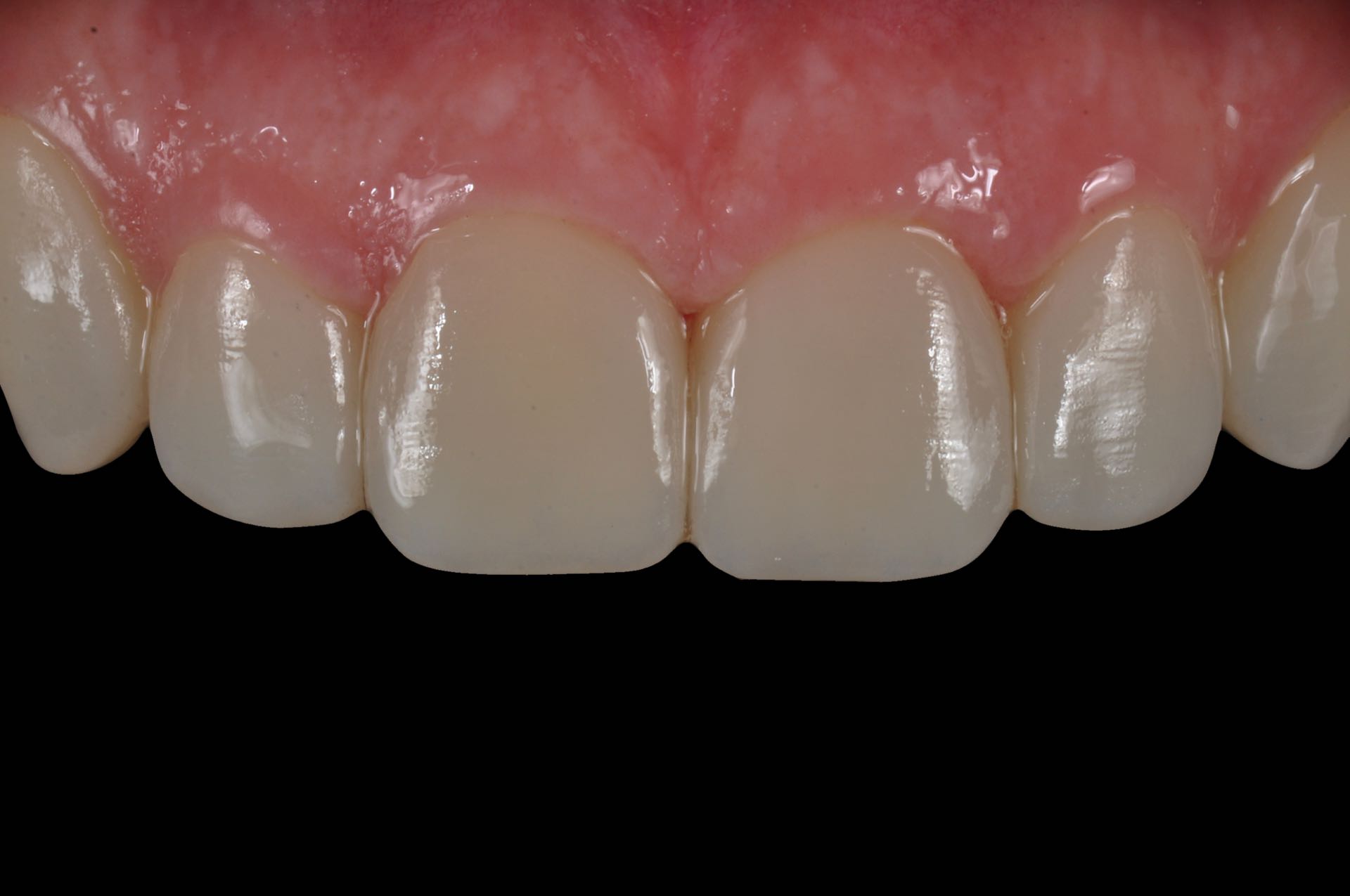 denti bianchi con faccette dentali