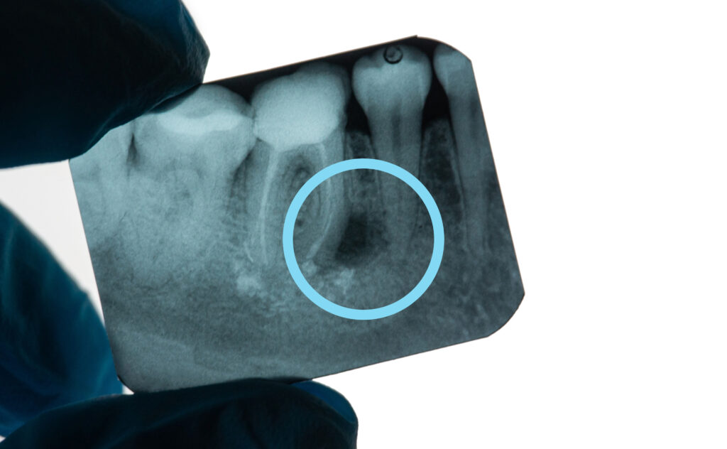 Granuloma Dentale by ADC Dental Center