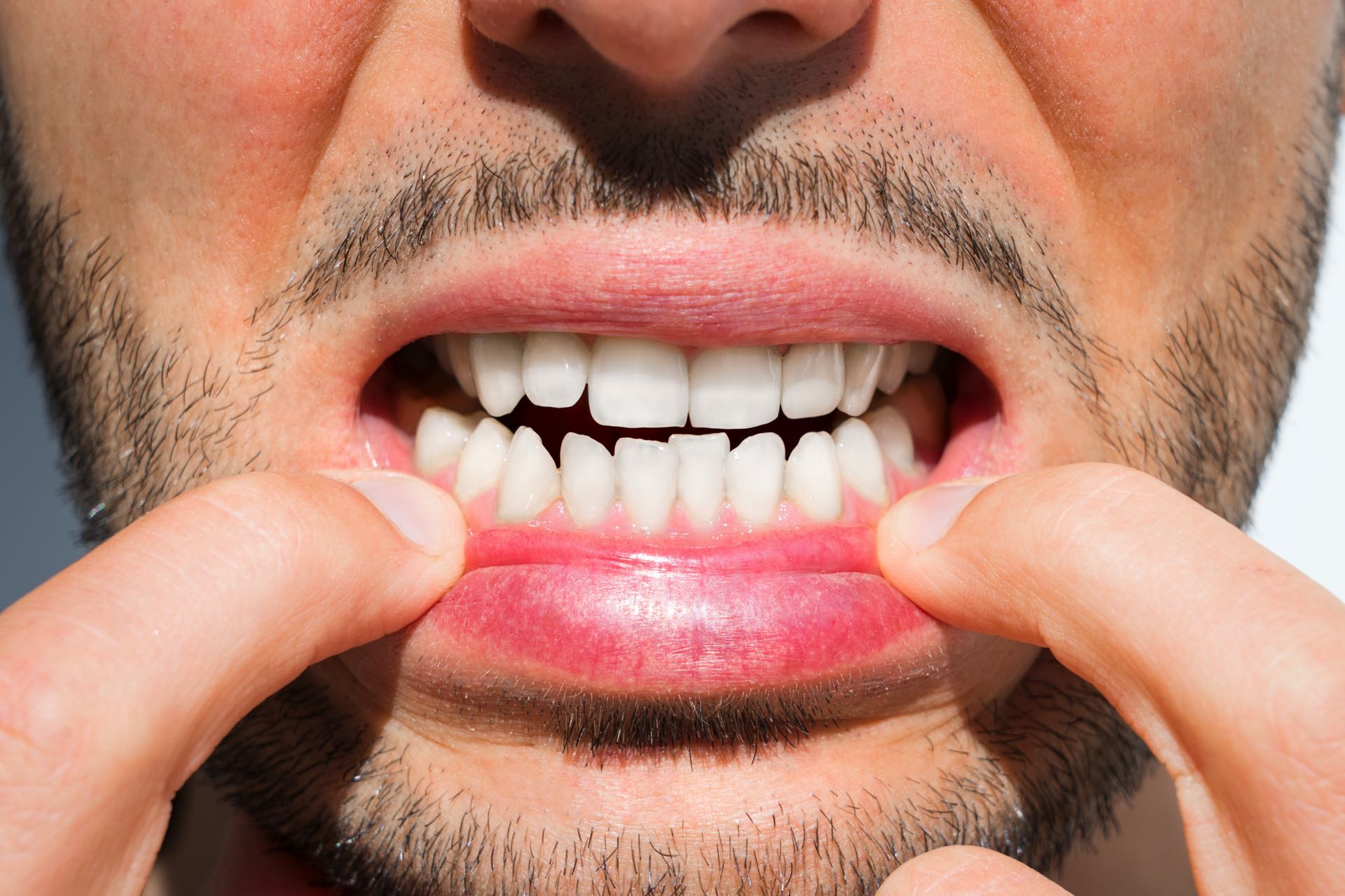 Cosa è il sovraffollamento dentale?