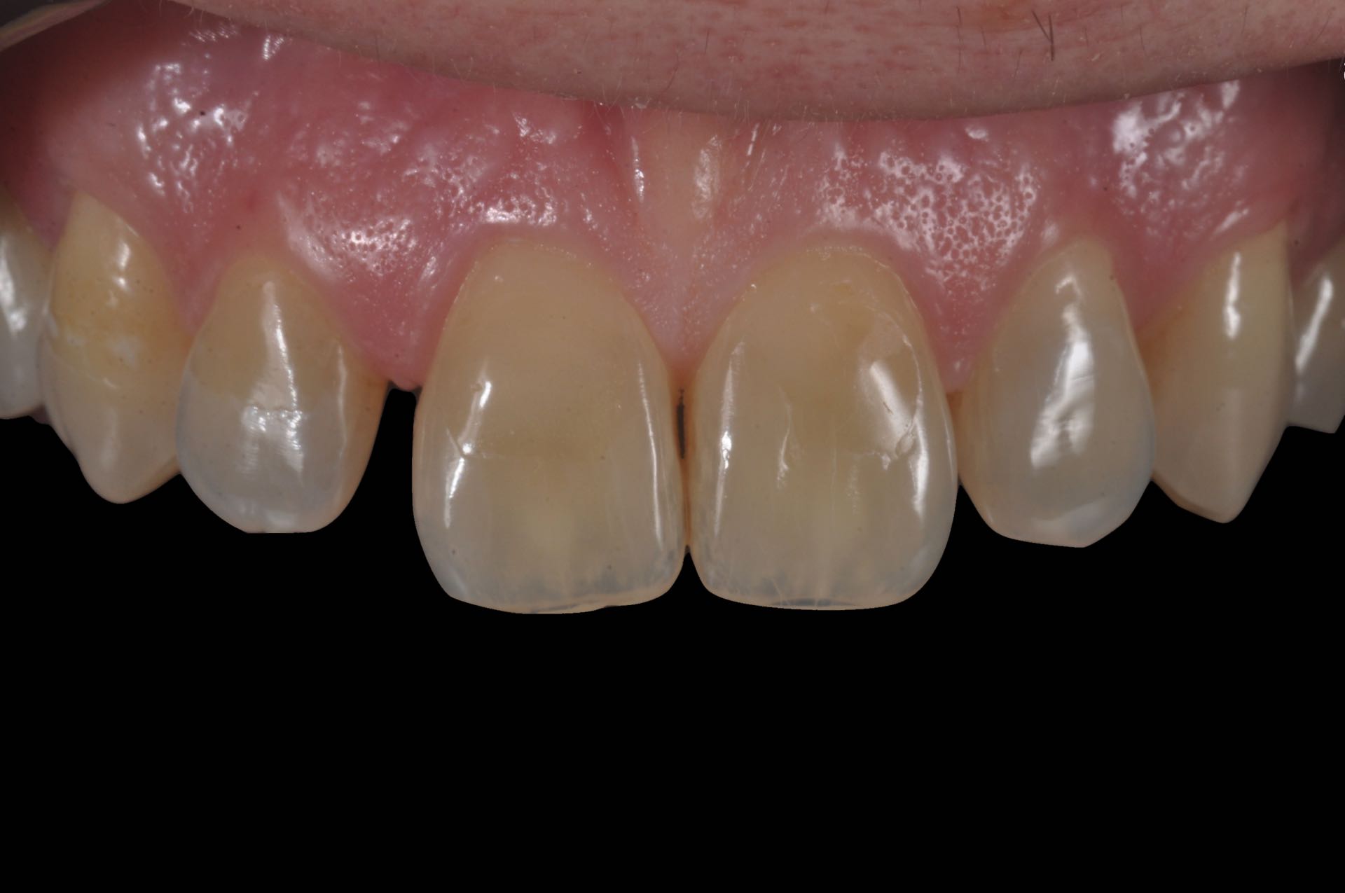 spazio tra i denti faccette dentali