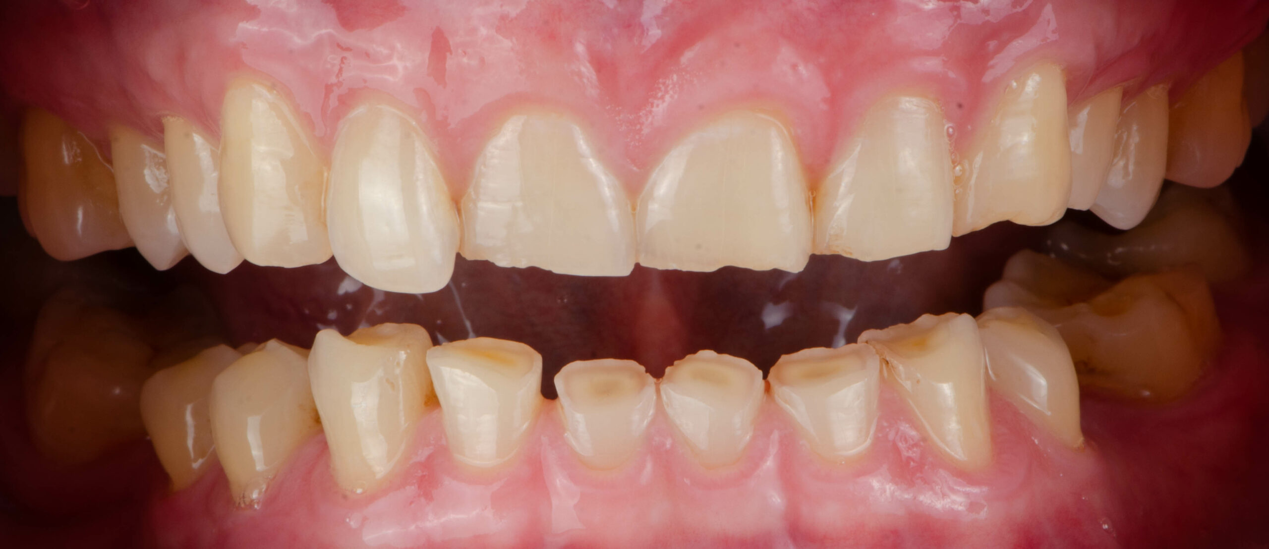 Usura anomala dei denti: cause e soluzioni