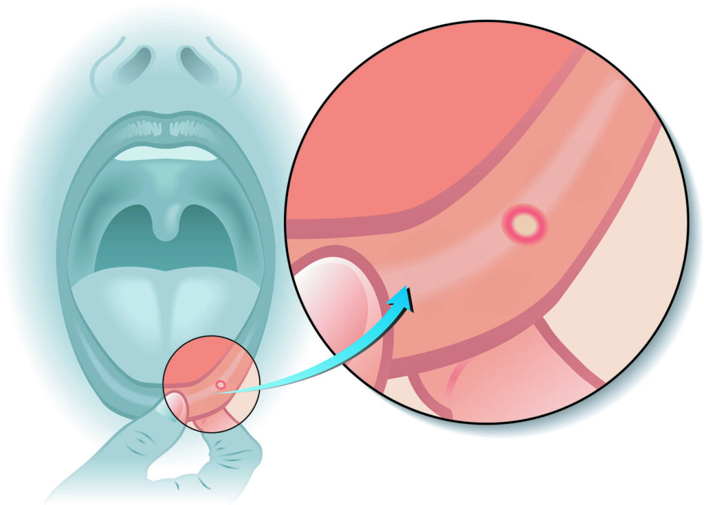 afte bocca by ADC DENTAL CENTER