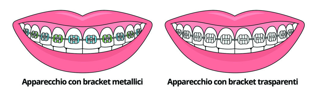 apparecchio trasparente by ADC DENTAL CENTER