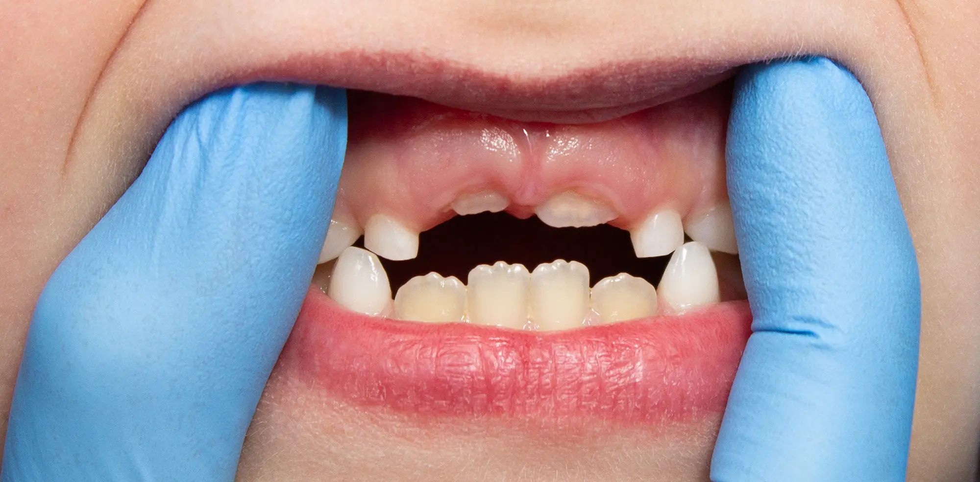 Febbre da dentizione: Guida per i genitori