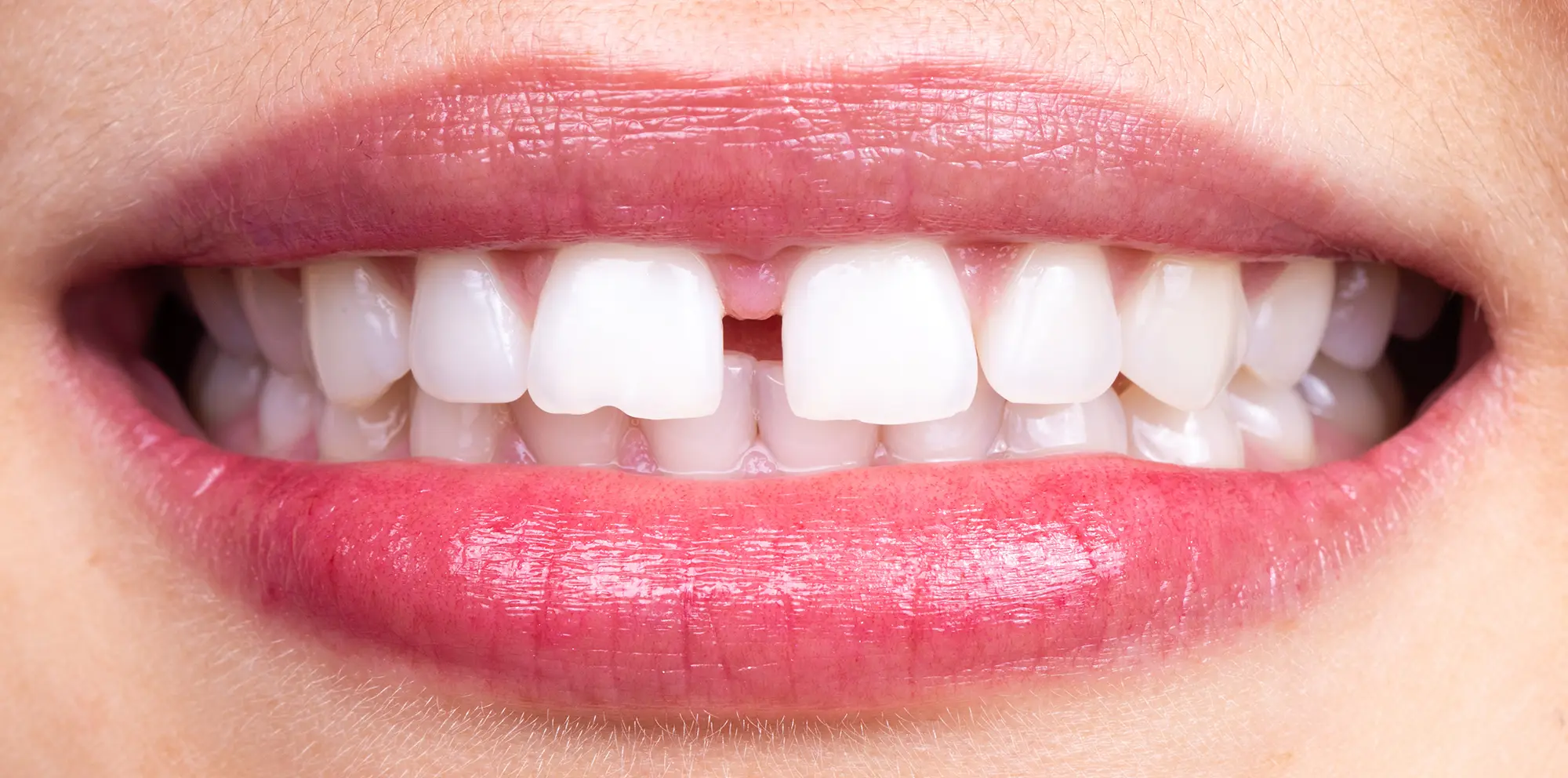 Diastema Dentale: Come si corregge lo spazio tra i denti?