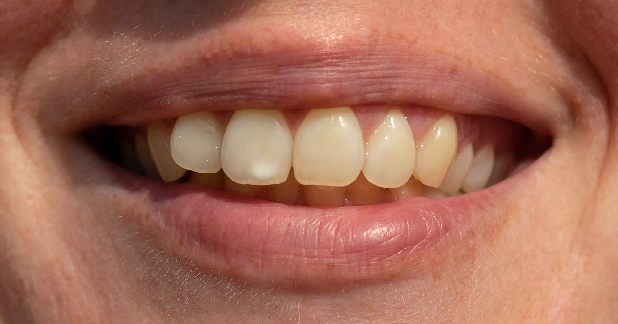 Macchie bianche sui denti: cosa sono e come risolvere?