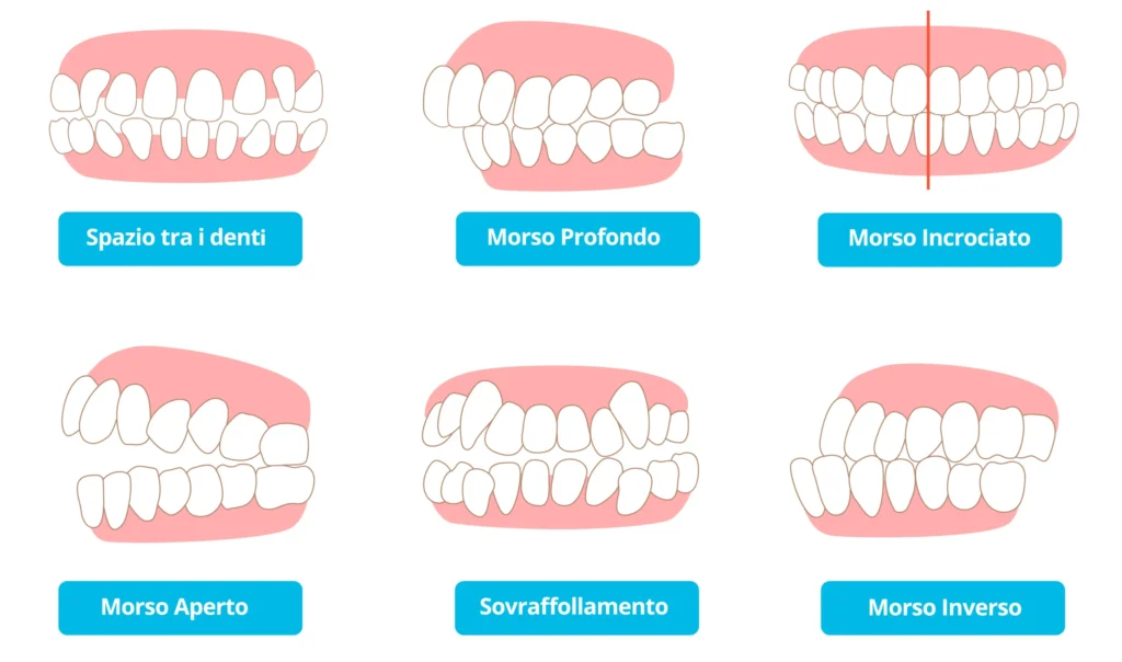 Tipologie di Malocclusioni Dentali