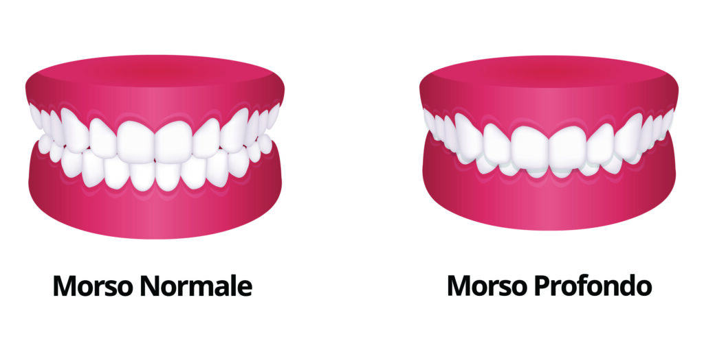 morso profondo by adc dental center