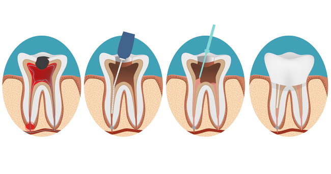 procedimento di devitalizzazione dente